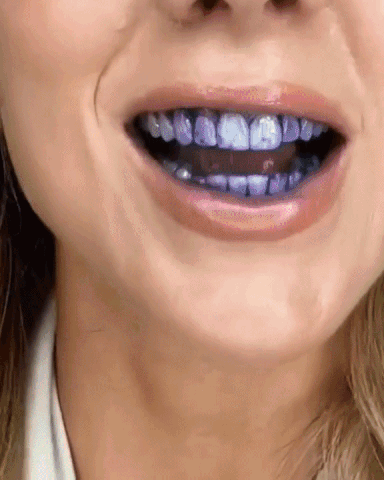 Violet Smile – Direct Wittere Tanden zonder Bleken
